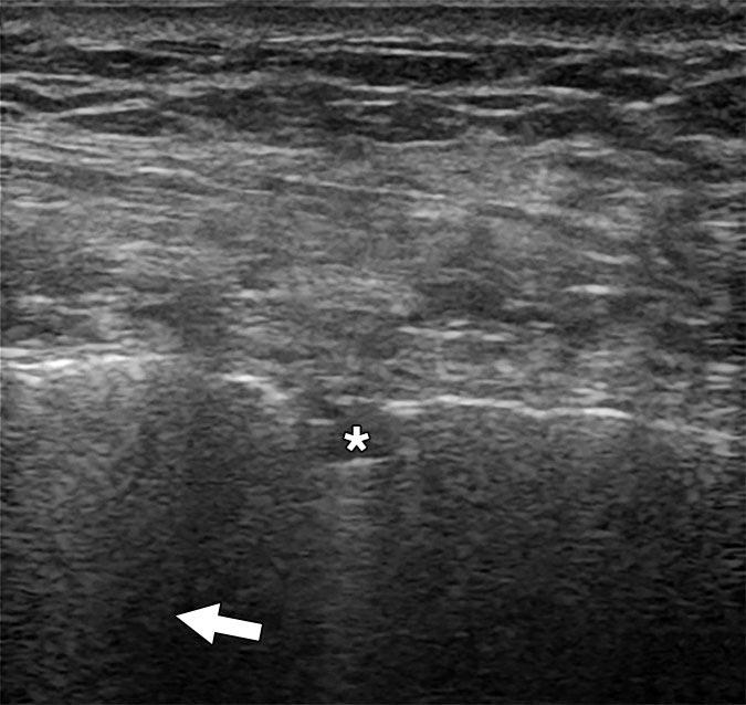 COVID-19 Lung Ultrasound