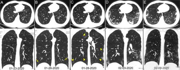 Description: Chest CT images of a 29-year-old man with fever for 6 days; RT-PCR assay for the SARS-CoV-2 using a swab sample was performed on February 5, 2020, with a positive result: (A) normal chest CT with axial and coronal planes was obtained at the onset; (B) chest CT with axial and coronal planes shows minimal ground-glass opacities in the bilateral lower lung lobes (yellow arrows); (C) chest CT with axial and coronal planes shows increased ground-glass opacities (yellow arrowheads); (D) chest CT with axial and coronal planes shows the progression of pneumonia with mixed ground-glass opacities and linear opacities in the subpleural area; (E) chest CT with axial and coronal planes shows the absorption of both ground-glass opacities and organizing pneumonia. Image credit: Ai et al, doi: 10.1148/radiol.2020200642.