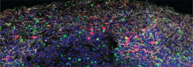 SARS-CoV-2 can infect neurons and damage brain tissue, study indicates