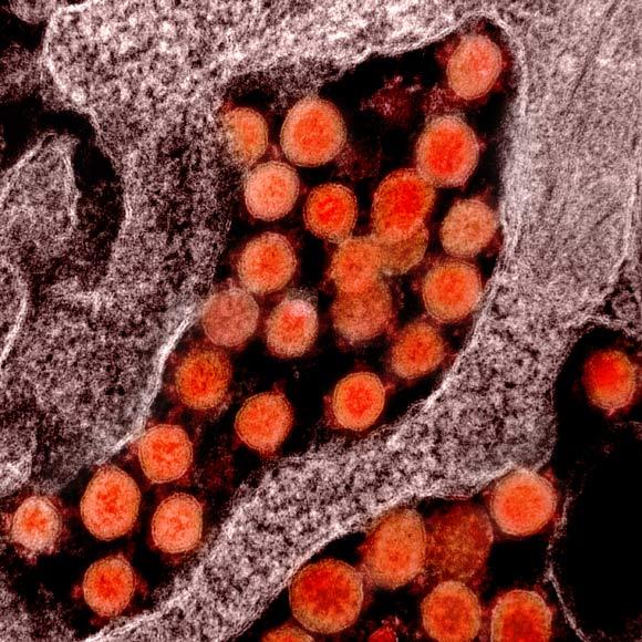 Transmission electron micrograph of SARS-CoV-2 virus particles, isolated from a patient. Image credit: NIAID.