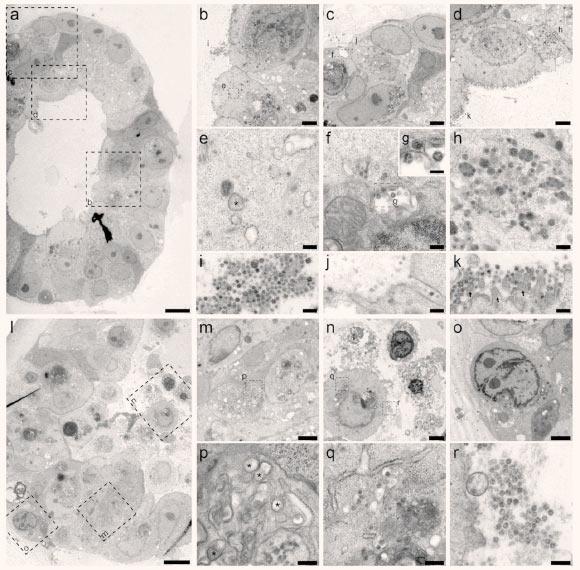 Transmission electron microscopy analysis of SARS-CoV-2 infected intestinal organoids: (a to h) overview of an intact organoid (a) showing the onset of virus infection (b to d) at different stages of the viral lifecycle, i.e., early double membrane vesicles (DMVs); (e), asterisk, initial viral production in the Golgi apparatus (f and g) and complete occupation of virus particles inside the endomembrane system (h); (i to k) extracellular viruses are observed in the lumen of the organoid (i), and are found at the basal (j) and apical side (k) alongside the microvilli (arrows). Scale bars - 10 μm (a), 2.5 μm (b to d), 250 nm (e), (f), and (h to k) and 100 nm (g). (l to q) Overview of an organoid (l) showing severely infected cells (m and o), disintegrated cells (o) and stressed cells as evident from the atypical nucleoli (p); intact cells reveal DMV areas of viral replication (p), asterisks, and infected Golgi apparatus (q); (r) extracellular clusters of viruses. Scale bars - 10 μm (l), 2.5 μm (m to p) and 250 nm (p to r). Image credit: Lamers et al, doi: 10.1126/science.abc1669.